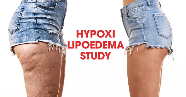 Hypoxi Helps Relieve Symptoms Of Lipoedema Hypoxi Usa